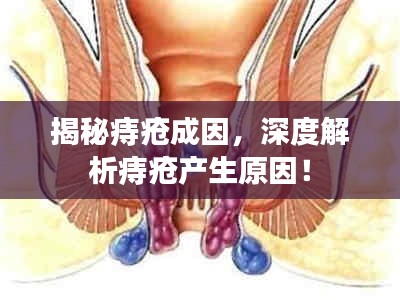 揭秘痔瘡成因，深度解析痔瘡產(chǎn)生原因！