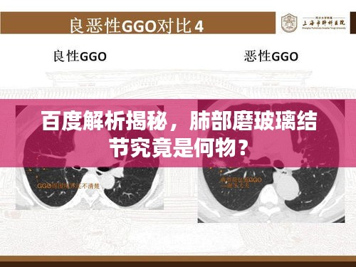 百度解析揭秘，肺部磨玻璃結(jié)節(jié)究竟是何物？